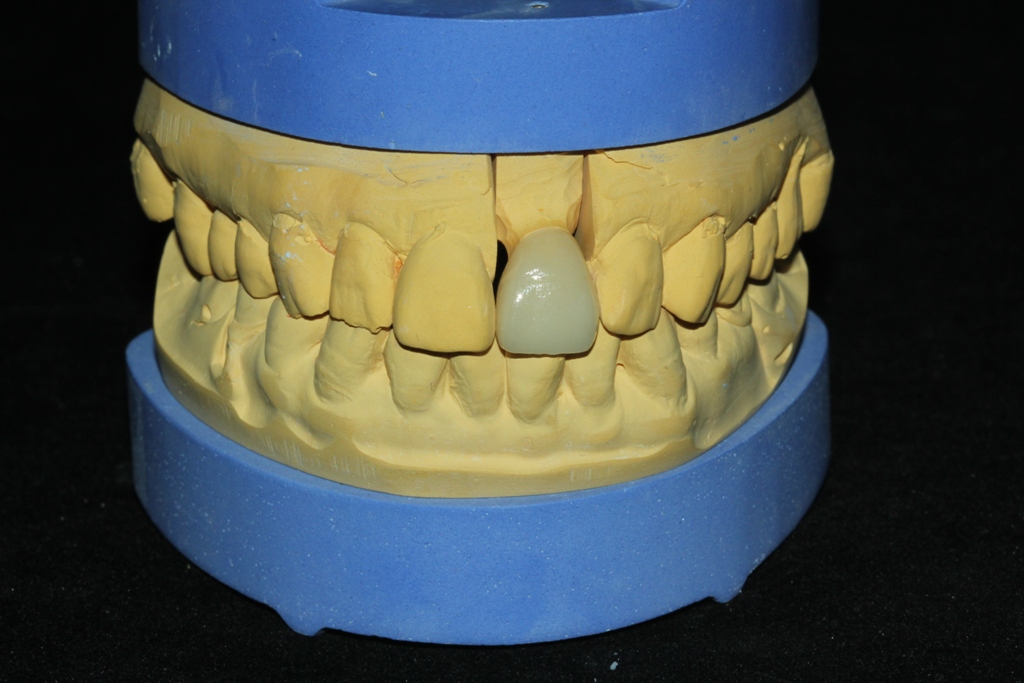 瓷貼面與樁冠聯合修復前牙缺損一例
