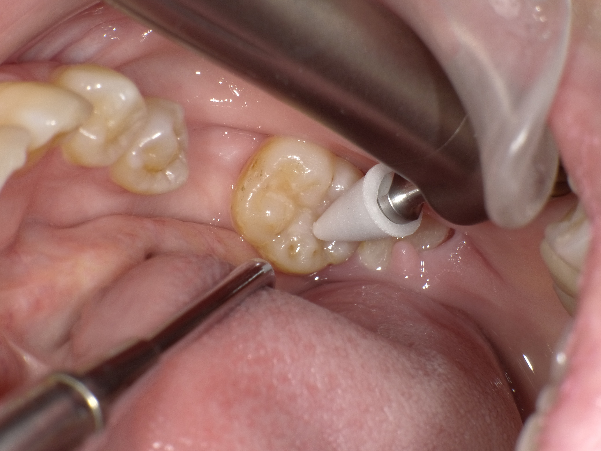 术后颌面及远中边缘嵴的树脂修复完成病例2 beautifilflow的楔状缺损