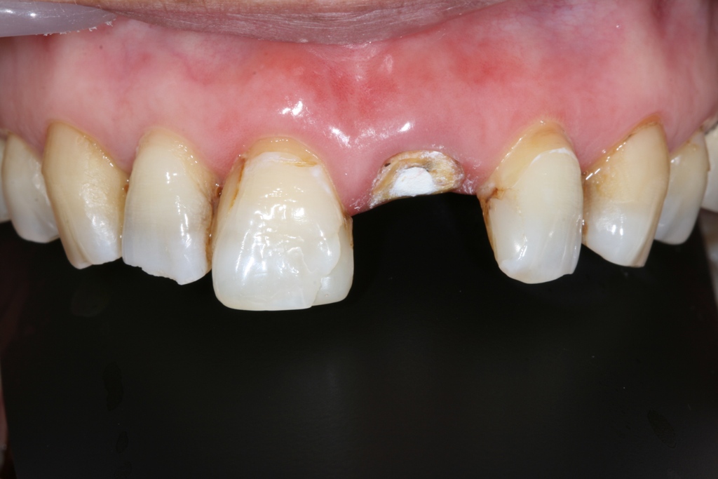 瓷贴面与桩冠联合修复前牙缺损一例