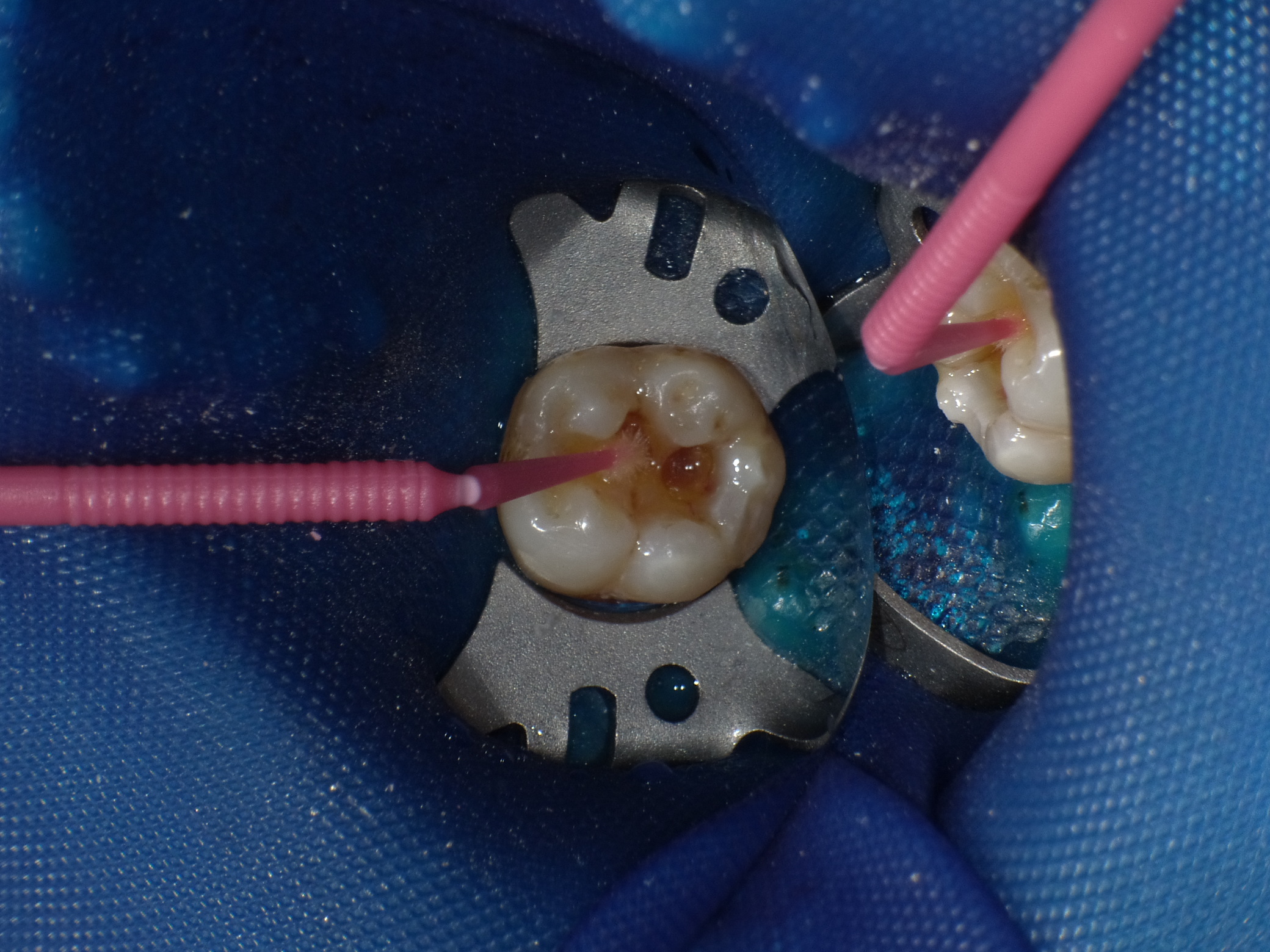 基于beautiful flow plus 的树脂修复