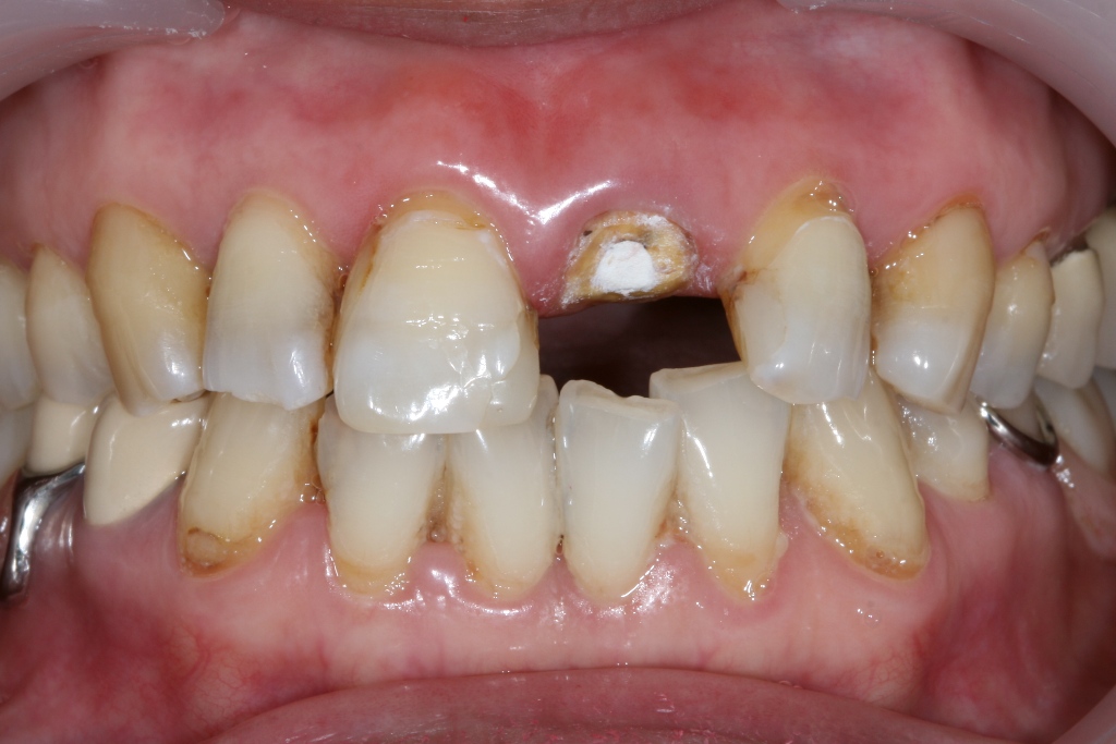 瓷贴面与桩冠联合修复前牙缺损一例