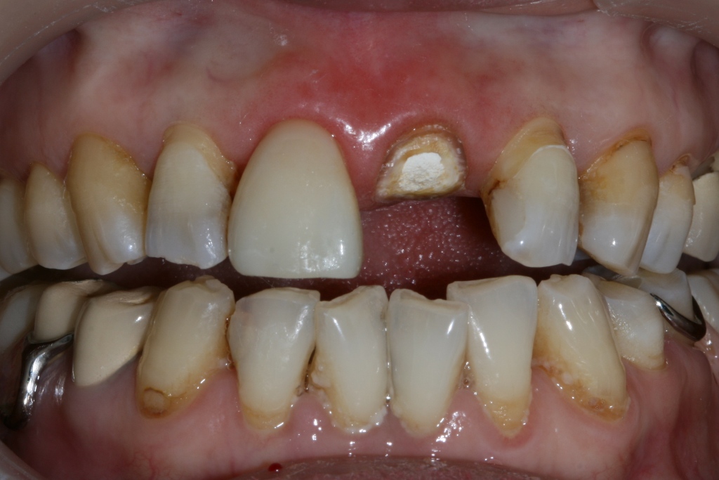 瓷貼面與樁冠聯合修復前牙缺損一例