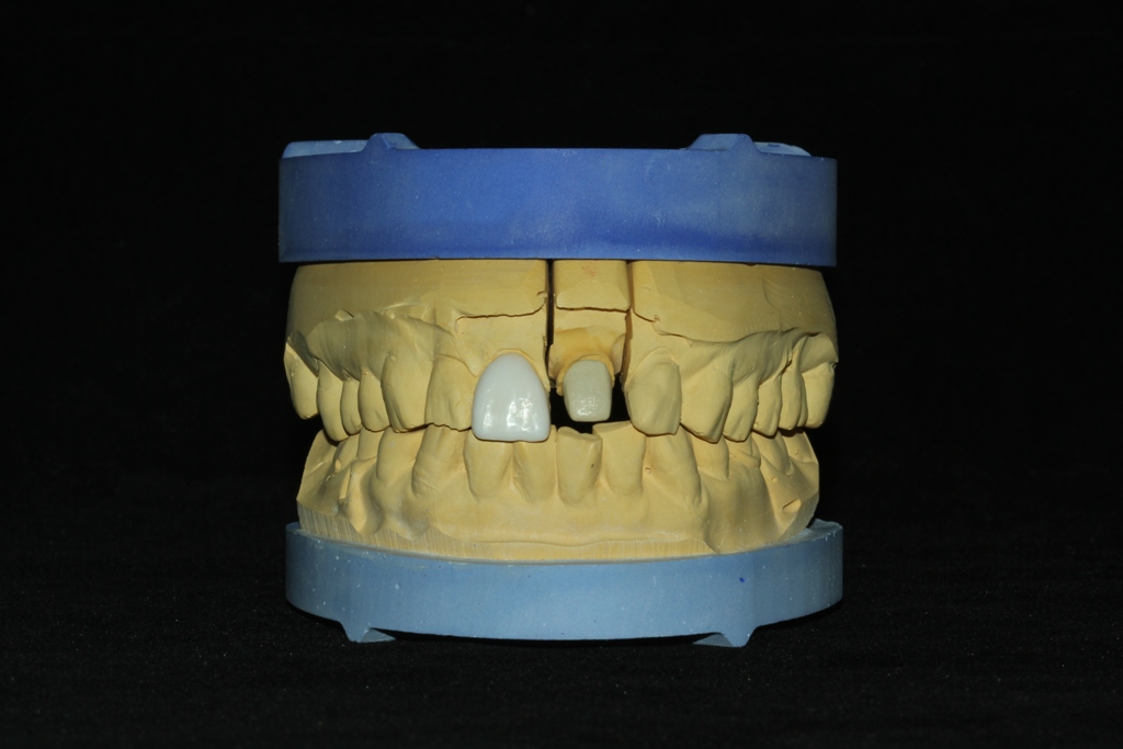 瓷貼面與樁冠聯合修復前牙缺損一例